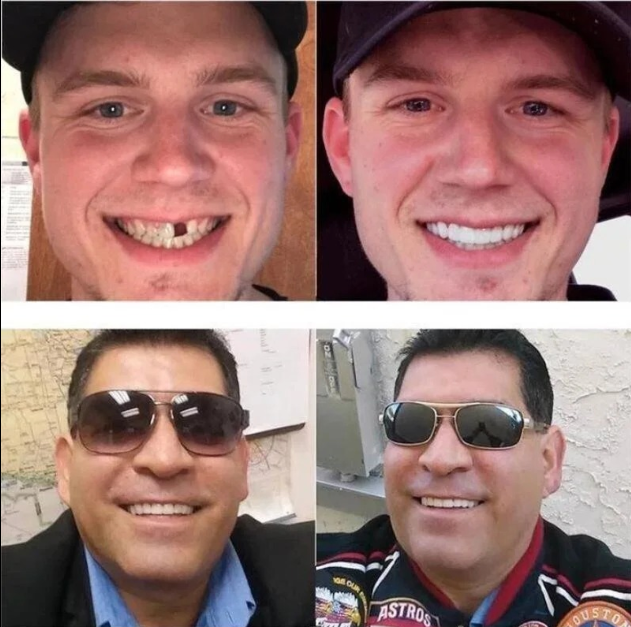 Dentures Snap-On Cosmetic Teeth for Missing, Crooked, or Damaged Teeth